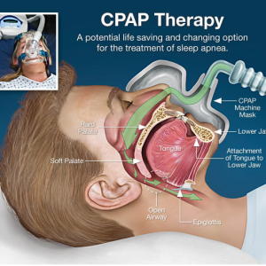 CPAP Therapy