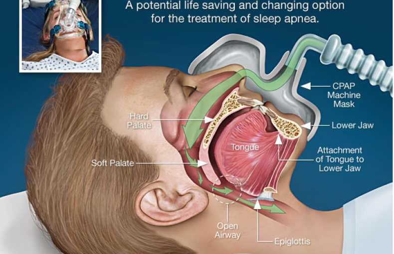 CPAP Therapy